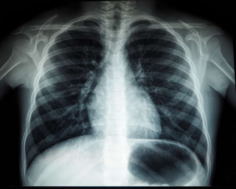 What Do Chest X-Rays Show?