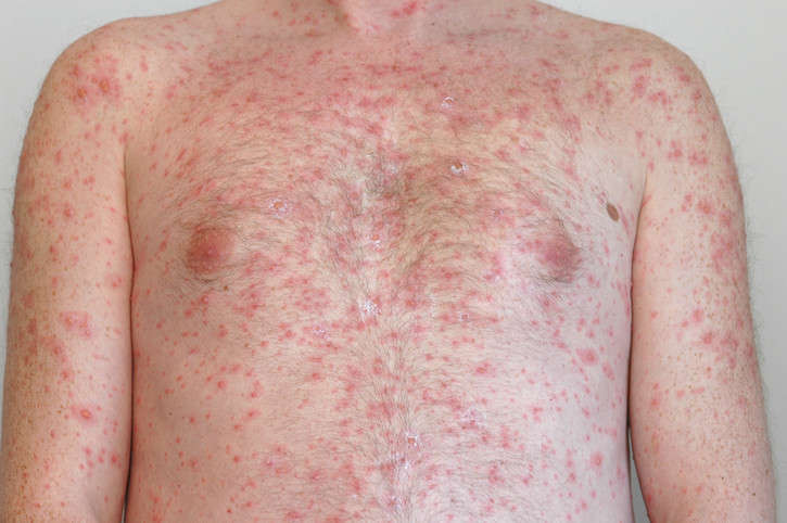 Shingles Prevention and New Vaccines on the Horizon
