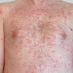 Shingles Prevention and New Vaccines on the Horizon