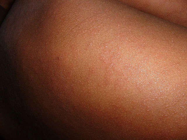 measles skin rash
