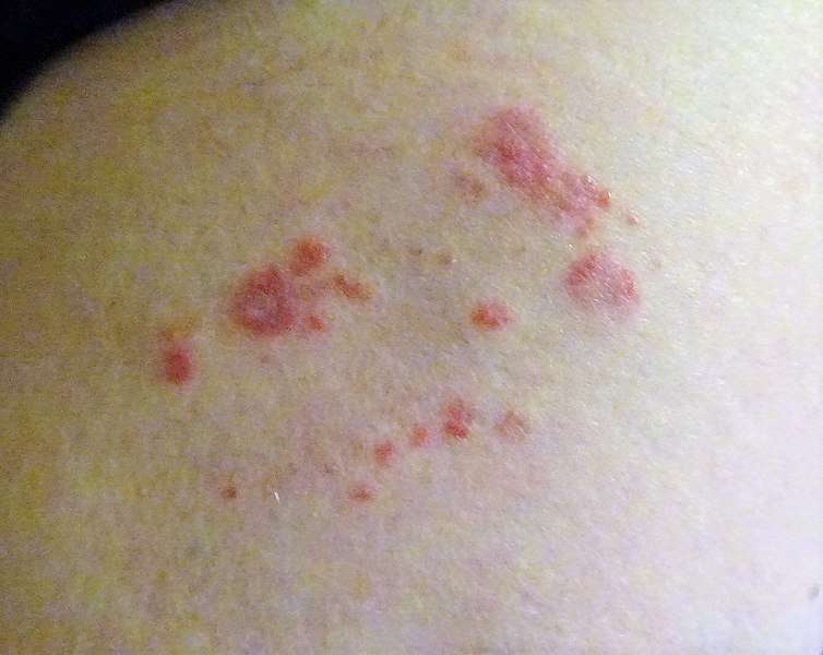 Shingles What it is, Symptoms, and How to Prevent It